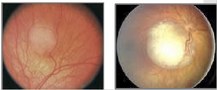 <ul><li><p>Occurs in approximately 1 in 20,000 births</p></li><li><p>Most common intraocular malignancy of childhood</p></li><li><p>Mean age at diagnosis: 18 months</p></li><li><p>Almost all cases diagnosed before 4 years of age</p></li></ul><p></p>