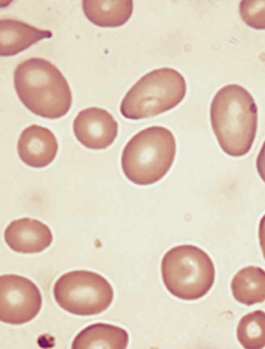 <p>Seen with megaloblastic anemia common in B12 and folate deficiency</p>