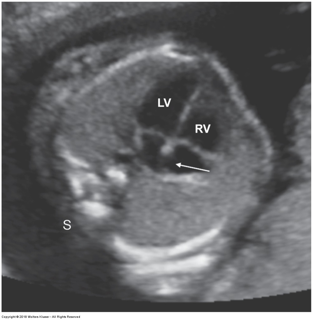 <p>the arrow in the following image is pointing to what?&nbsp;</p><ul><li><p>foramen ovale</p></li><li><p>ductus arteriosus</p></li><li><p>mitral valve</p></li><li><p>tricuspid valve</p></li></ul><p></p>