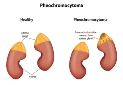 <p>Epinephrine is a catecholamine secreted by the adrenal gland that <strong>stimulates glucagon</strong> secretion and <strong>inhibits insulin </strong>secretion</p><p>Increased production is seen in physical or emotional stress (fight or flight) and in pheochromocytomas (adrenal medulla tumor)</p>