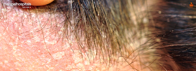 <p>Sebhorric dermatitis</p>