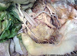 <p>what artery is being indicated to in the image? context: left lobe of liver has been removed</p>