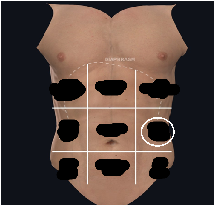 <ul><li><p><span style="background-color: transparent;">Lateral to umbilical</span></p></li><li><p><span style="background-color: transparent;">At the waist</span></p></li></ul><p></p>