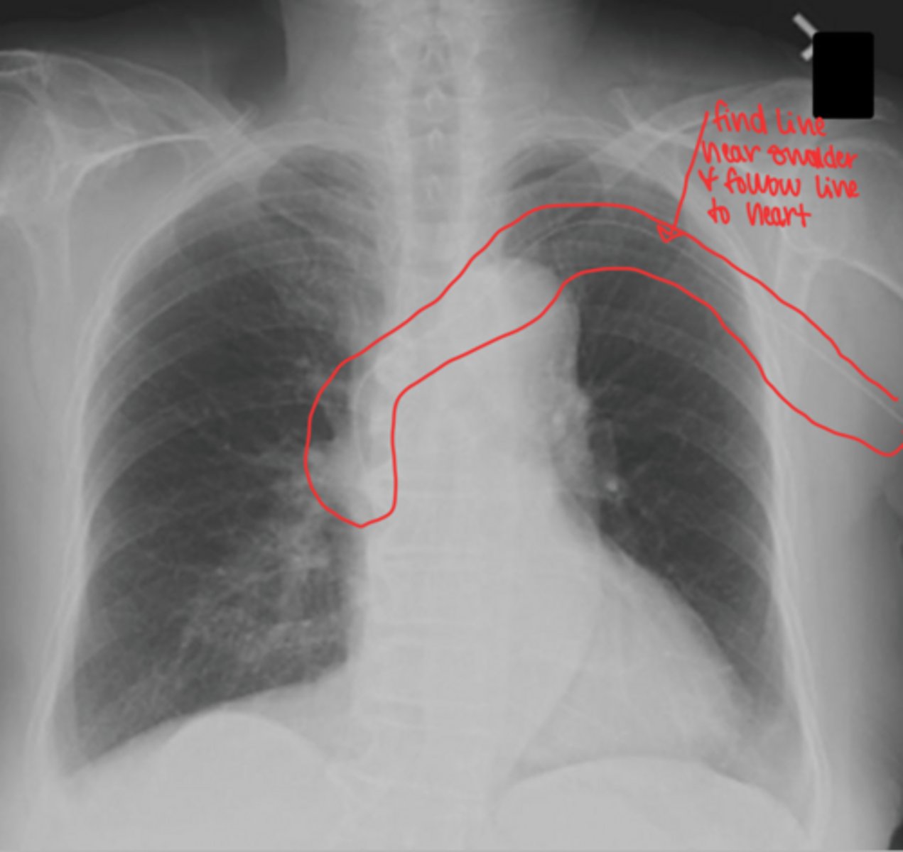 <p>find line near shoulder and follow line to the heart</p>