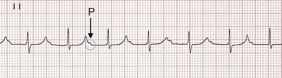 <ul><li><p><strong>prolonged PR</strong> intervals</p></li><li><p>contraction delayed due to increased time for AVconduction</p></li></ul><p></p>