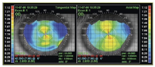 <ul><li><p>Axial maps: best represent the optical characteristics of the cornea; commonly preferred in refractive surgery</p></li><li><p>Tangential maps: represent true/local curvature better and provide better peripheral shape information; preferred in contact lens practice</p></li></ul><p></p>