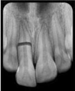 <p>Which trauma:</p><ul><li><p>Coronal segment mobile + displaced</p></li><li><p>Tender to percussion</p></li><li><p>Bleeding from gingival sulcus</p></li><li><p>False negative initially</p></li></ul><p></p>