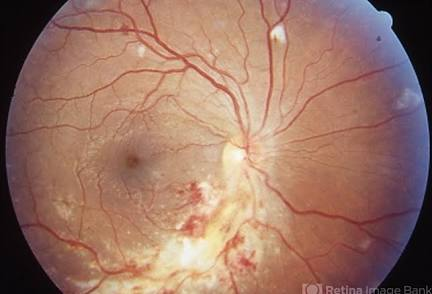 <p><strong>Answer:</strong><br><strong>CMV retinitis</strong></p><p><strong>Classic appearance:</strong><br>“Pizza-pie” or “cottage cheese and ketchup” retina.</p><p><strong>Treatment:</strong><br>Valganciclovir or IV ganciclovir, depending on severity.</p><p><strong>Memory:</strong><br><strong>CMV = can’t see below 50. </strong></p>