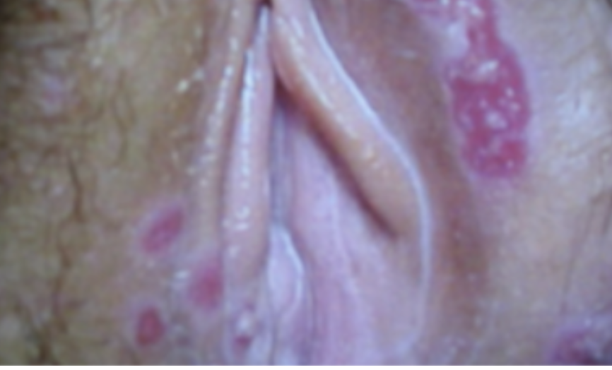 <p>🖼️‼️(#18,#71)42.Recommended treatment for this lesion includes the following EXCEPT: A.Azithromycin B.Ceftriaxone C.Ciprofloxacin D.Doxycycline</p>