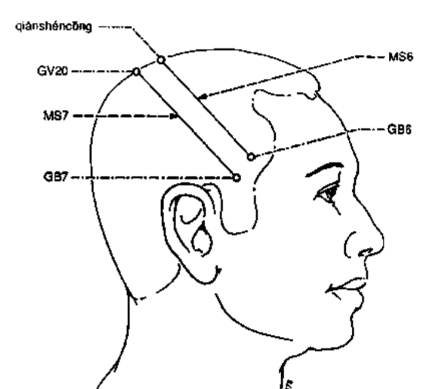 <p>From DU 20 obliquely to GB 7</p><p>upper 1/5: parethesia &amp; sensory disturbance in the trunk and lower limbs, formication (hallucinations of feeling bugs crawling on the skin) </p><p>middle 2/5: sensory impairment in upper limbs</p><p>lower 2/5: sensory impairment in head and face</p>