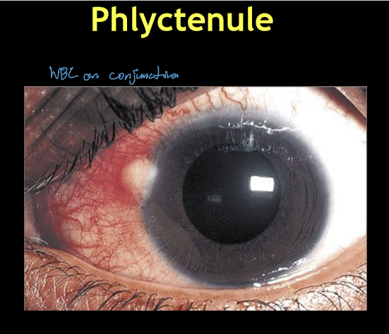 <p>Anterior blepharitis</p>