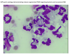 <p>TCC </p><p>- normal: <0.3 X 10^9 cells/L </p><p>- septic: >30 X 10^9 cells/L</p><p>TP</p><p>- Normal: <25 g/L </p><p>- septic: >40 g/L </p><p>Cell populations</p><p>- Normal: <10% neuts </p><p>- Septic: >90% PMN (Degenerate neutrophils are main sign - may not see bacteria at all despite being septic. )</p><p>*NB OSTEOARTHRITIS IS MILD INCREASED FROM NORMAL, SEPTIC IS SEVERELY INCEASED</p>