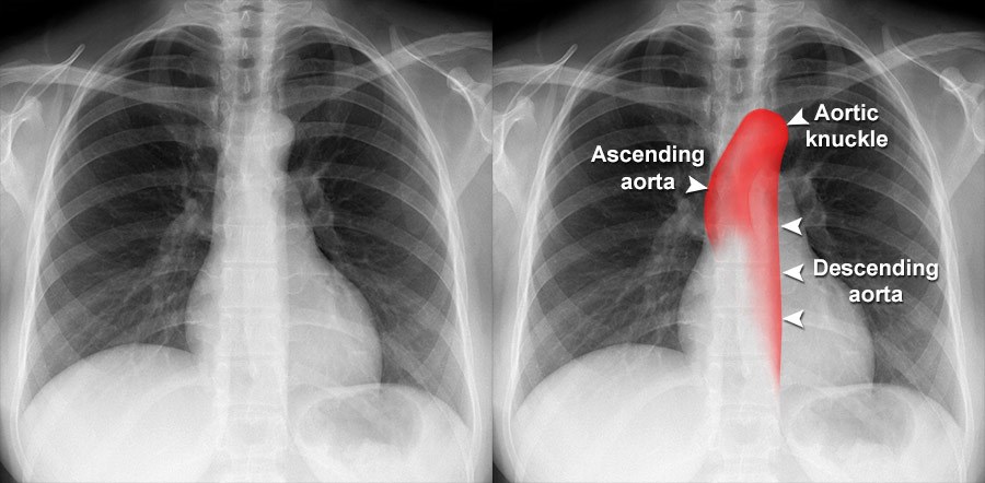 <p>Extends from the heart to L4. The thoracic aorta above the diaphragm. Located in the mediastinum.</p>