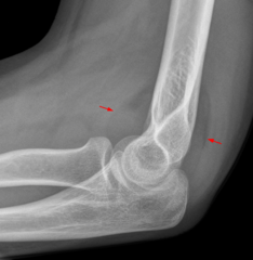 <p>indicates hemarthrosis in radial head fx</p>