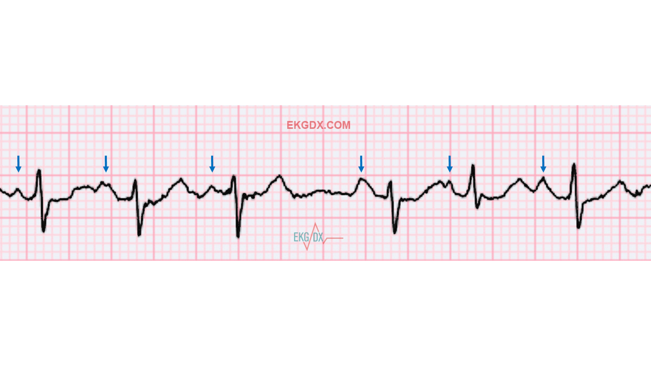<p>Multifocal atrial tachycardia and wandering atrial pacemaker (WAP)</p>
