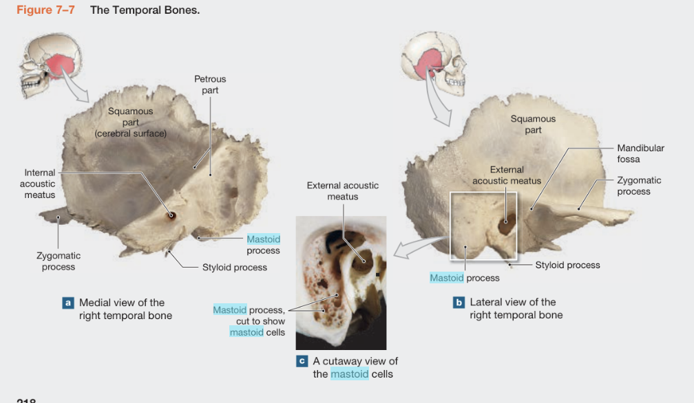 <p><span style="background-color: transparent;">Temporal bone:</span></p><p><span style="background-color: transparent;">Mastoid process: Rough, conical projection behind the ear. (</span><span data-name="warning" data-type="emoji">⚠</span><span style="background-color: transparent;"> Look-alike: Styloid process is thin and needle-like).</span></p><p><span style="background-color: transparent;">· External auditory (acoustic) meatus: The ear canal opening.</span></p><p><span style="background-color: transparent;">· Zygomatic process: The bridge of bone extending forward to meet the cheekbone.</span></p><p><span style="background-color: transparent;">· Mandibular fossa: The smooth depression where the lower jaw (mandible) articulates.</span></p><p><span style="background-color: transparent;">· Styloid process: Sharp, needle-like projection pointing downward from the temporal bone.</span></p><p><span style="background-color: transparent;">· Carotid canal: A circular opening on the inferior surface of the temporal bone (where the carotid artery enters).</span></p><p><span style="background-color: transparent;">· Jugular foramen: A large opening at the base of the skull between the temporal and occipital bones.</span></p><p><span style="background-color: transparent;">Zygomatic arch: The complete cheekbone bridge</span></p>