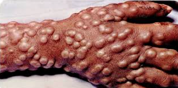 <p>Causative Agent: Variola major<br>Symptoms/Signs: Rash emerges in the mouth, Severe abdominal and back pain, Rash spreads throughout body within 24 hours creating pustules which eventually crust over and fall off leaving scar tissue.</p>