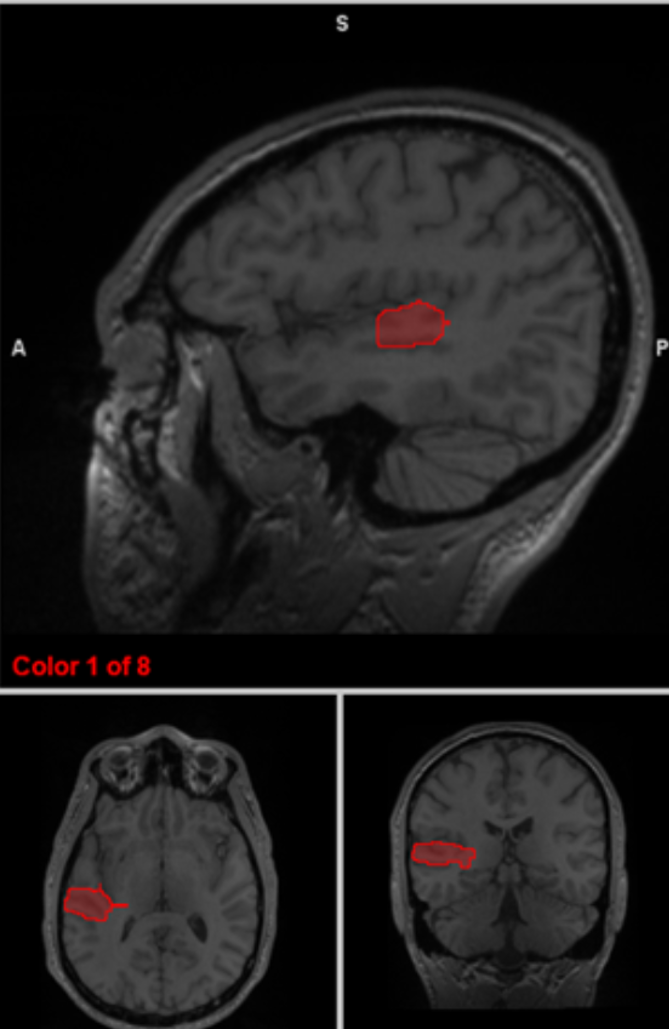 <p>insular cortex</p>
