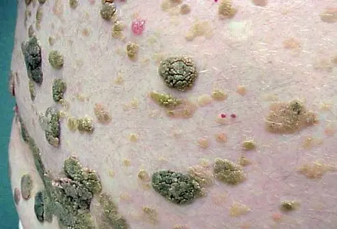 <p>A waxy, scaly, raised lesion that often appears “stuck on”.</p>