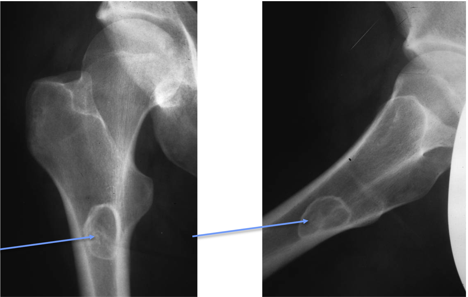 <p>What tumour like disorder is this, what can you see?</p>