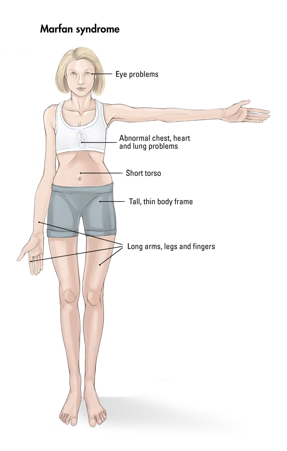 <ul><li><p>very tall with long, slender limbs</p></li><li><p>due to excessive cartilage formation at epiphyseal plates</p></li><li><p>can cause life-threatening cardiovascular problems</p></li></ul><p></p>