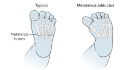 <p>Generally, self-limiting that condition that causes the forefoot to turn inwards</p><p>Visible at birth</p><p>Flexible or rigid</p>