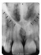 <p>Floor of Nasal Cavity</p>