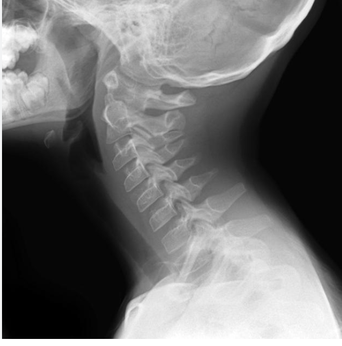 <p>Normally developed cephalic part of the dens is not fused with the C2 body; smooth, wide, lucent defect between the body of C2 body and dens </p>