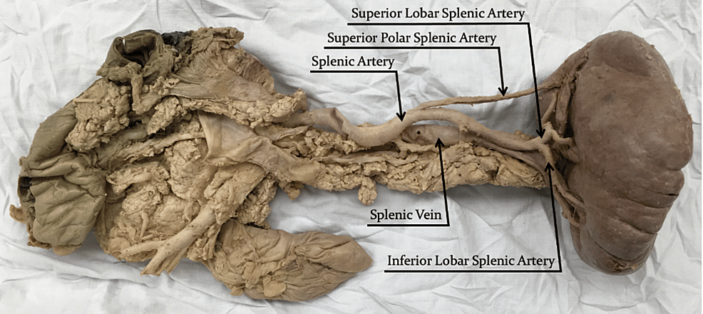 <p>right below the splenic artery</p><p>very thin walled</p>