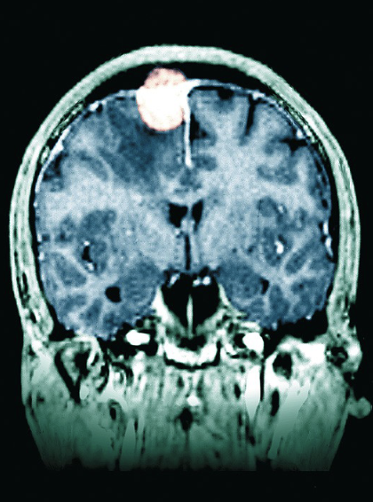 <ul><li><p>tumours that grow out of the meninges</p></li></ul><ul><li><p>close to the surface of the brain so they are easy to remove</p></li><li><p>typically benign</p></li></ul><p></p>