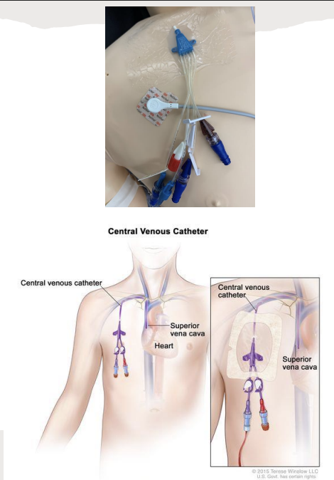 <p>Line</p><p>Purpose: delivery of fluids and medication; can be used for blood draw; can be used to monitor central venous pressure (CVP)</p>