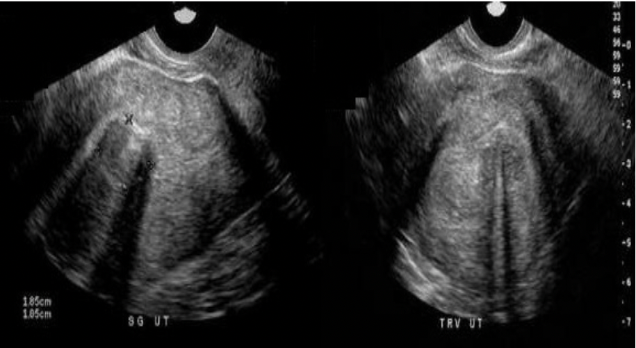 <p>What type of fibroid is seen in the image displayed?</p><p>A. Intramural</p><p class="p1">B. Submucosal</p><p class="p1">C. Subserosal</p><p class="p1">D. Pedunculated</p>