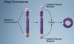 <p>- Ring forms when a chromosome loses its genetic material at the terminal portions and the ends fuse to form a ring-like structure</p><p>- Unbalanced → phenotype</p>