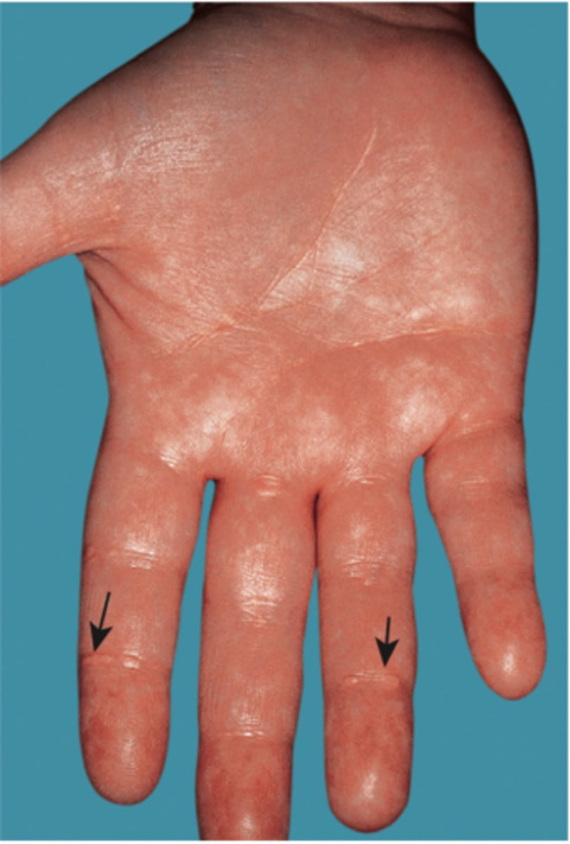 <p>fatty deposits under the surface of the skin</p>