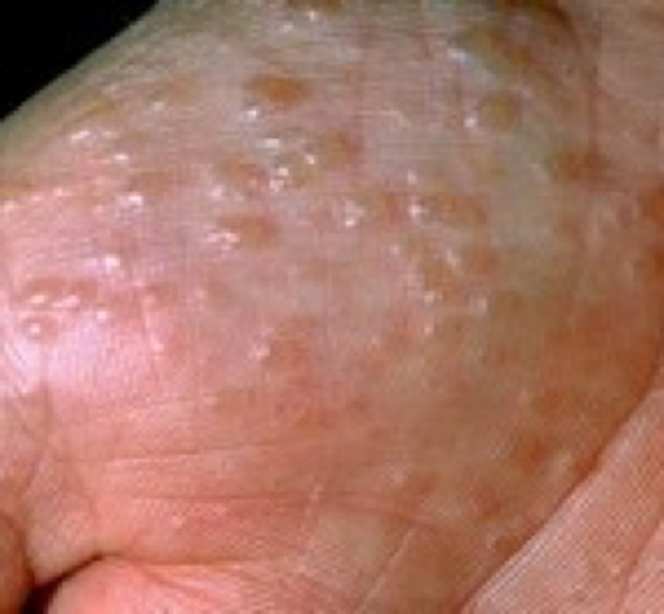 <p>psuedovesicular/vesicular</p><p>tapioca appearance (blistery)</p><p>very itchy (pruritic)</p>