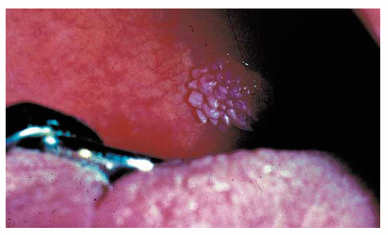 <p>1.what is this lesion?</p><p>2. how to treat/ manage it?</p>