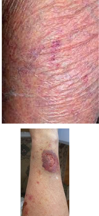 <p>What kind of lesion is this?</p>