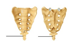 <p>disarticulated</p>