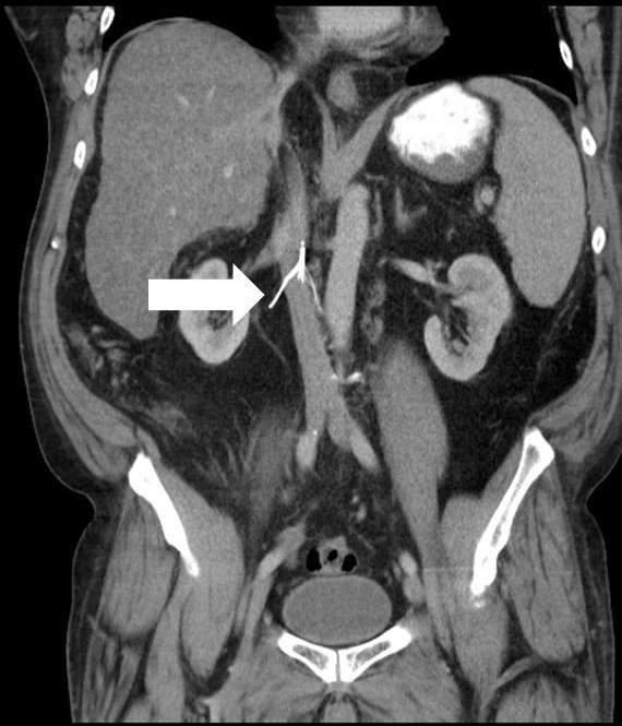 <p>What can you conclude from this image of an IVC filter?</p>