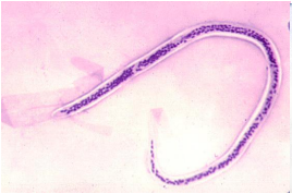 <p>a parasitic, thread-like roundworm responsible for approximately 90% of all cases of lymphatic filariasis. lymphatic blockage</p>
