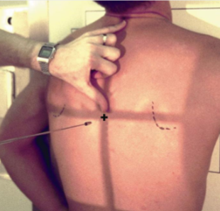 <p><strong>approximately at the level of the inferior angle (bottom tip) of the scapula</strong> when the arms are down</p>