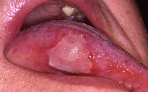 <p>radiation therapy induced </p>