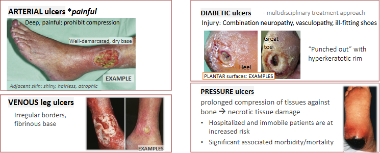 <ul><li><p>insufficiency → stasis → fibrin deposits + RBC breakdown → skin atrophy → ulcer</p><ul><li><p>venous HTN → poor O2 → varicose vein, CHF</p></li></ul></li><li><p>vascular disease (ischemia), neuropathy, systemic metabolic abnormalities, 2ndary infection</p></li><li><p>compromised vascularization <strong>(atherosclerosis)</strong> of peripheral a. → ischemia</p></li><li><p>mechanical pressure or local ischemia → tissue compression against bone (heels, post. pelvis, malleoli, greater trochanter)</p></li></ul><p></p>