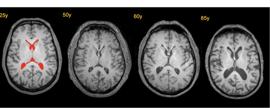 <ul><li><p>ventricles enlarge</p></li><li><p>cortex gets thinner- lose about 0.5% per year</p></li></ul><p></p>