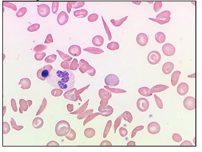 <p>How many sickle cells are there in this picture of the blood film?</p>