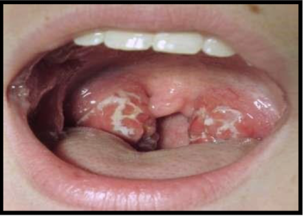 <p>what is this lesion associated with and what are they called</p>