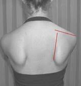 <p>SICK Scapula</p>