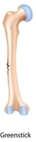 <p>GREENSTICK</p>