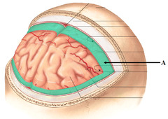 <p>space between dura mater and arachnoid mater</p>