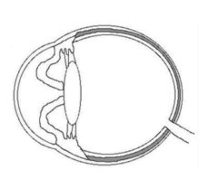 <p>If in posterior synechia, the attachment is circumferential, the movement of aqueous humor through the pupil is blocked and the iris will bow anteriorly, which is called __________ ________.</p>